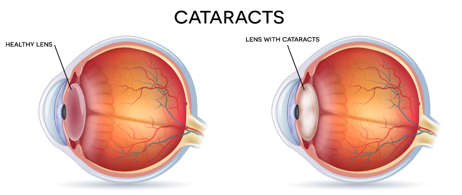 Cataract chart