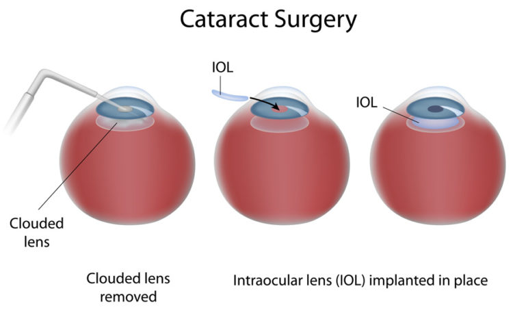 Cataract Surgery