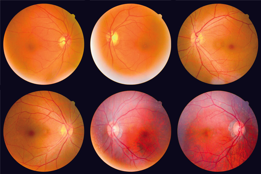 Collection of Retinal Images