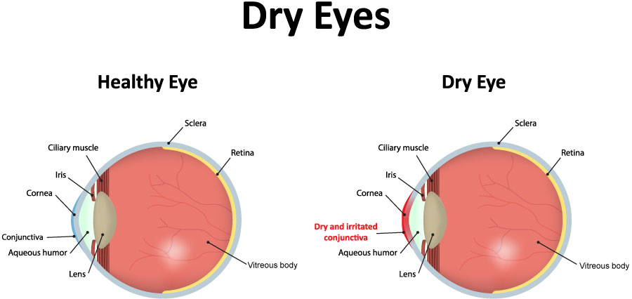 Dry Eyes Chart