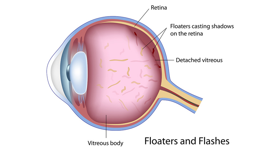 Flashes and Floaters