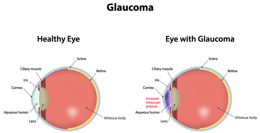 Glaucoma Chart