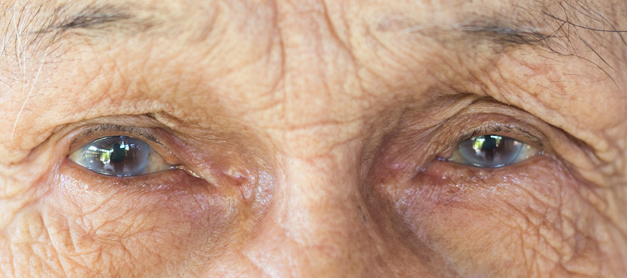 Senior with minor Cataract